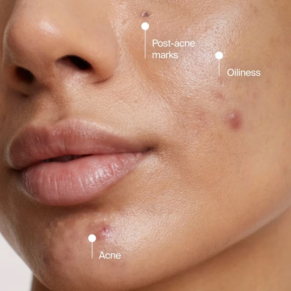 Neutrogena Evenly Clear Acne Cleansing Mask 125ml